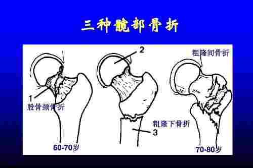 髋部骨折